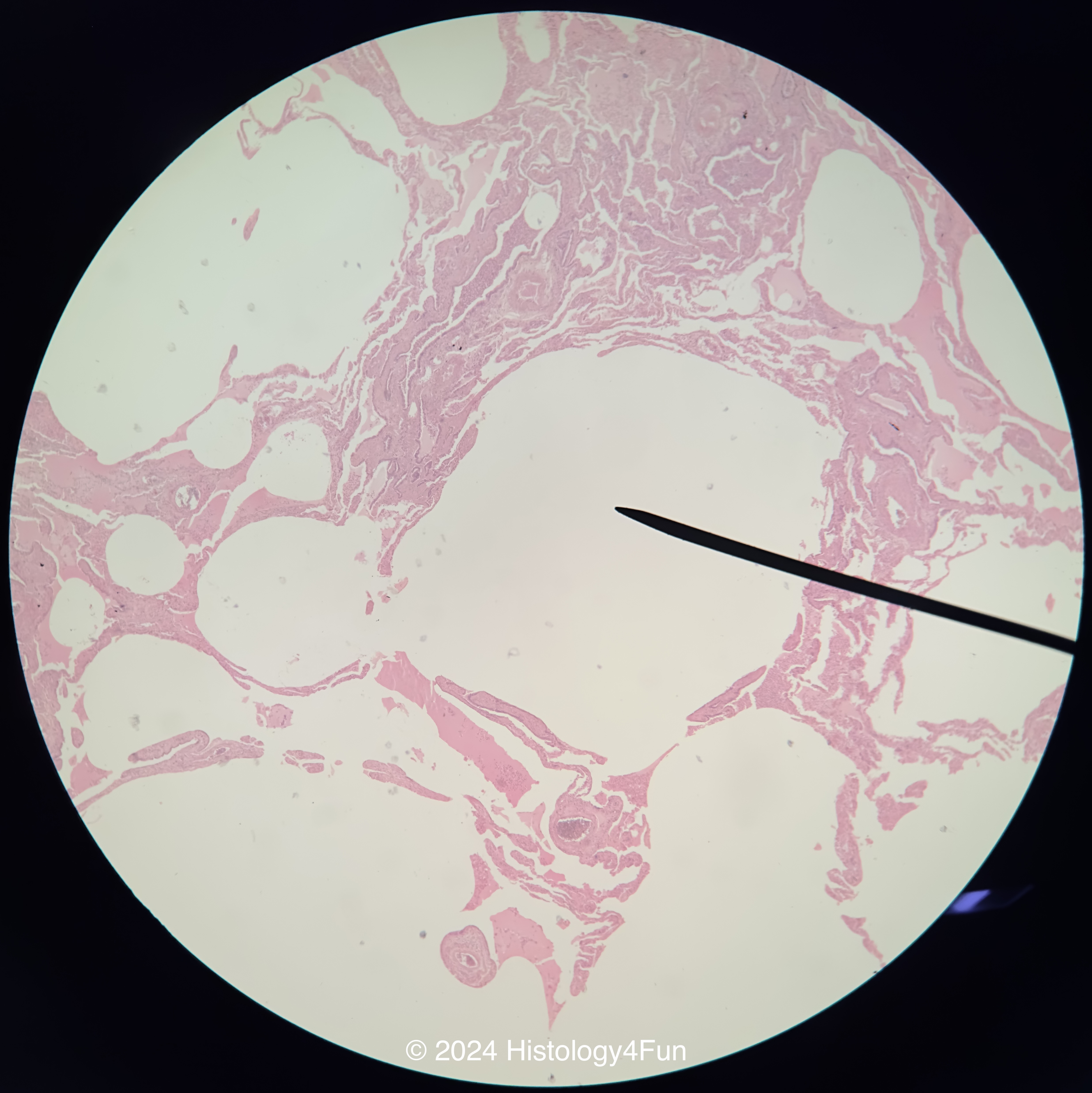 Lung - Emphysema 